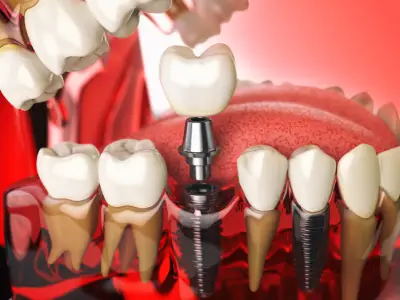 Dental Implants in Antioch