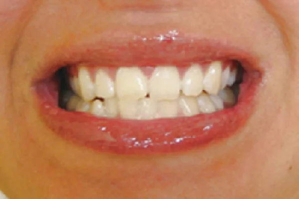 After Zoom Whitening