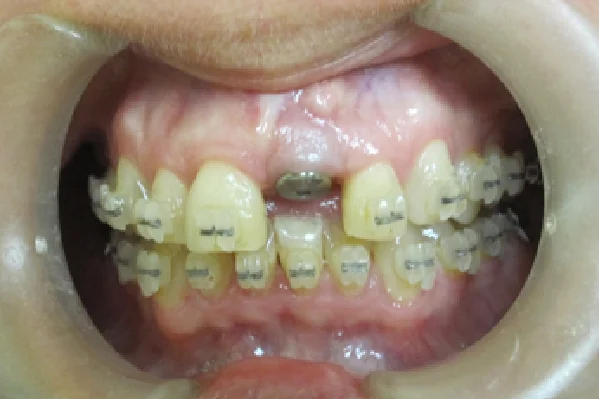 Before Anterior Implant for Missing Front Tooth