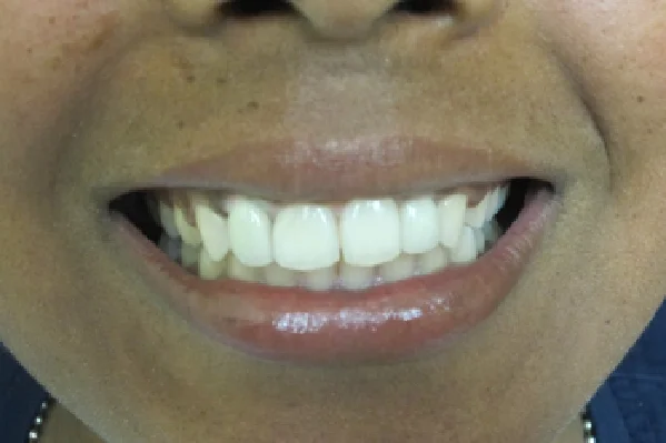 After Anterior Implant for Missing Front Tooth