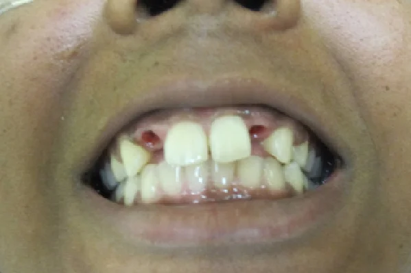 Before Anterior Implant for Missing Front Tooth