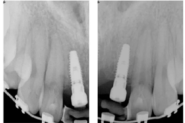 Before Anterior Implant for Missing Front Tooth - view 2