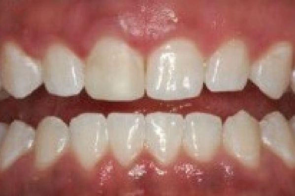 After Invisalign - Crowded Teeth