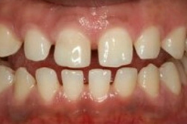 Before Invisalign - Crowded Teeth