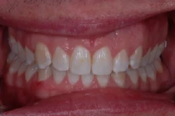 After Invisalign - Crowded Teeth - View 2