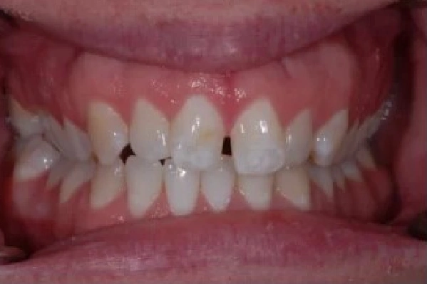 Before Invisalign - Crowded Teeth - View 2