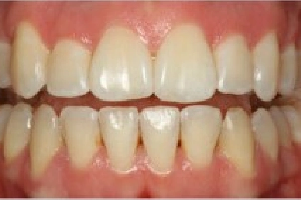 After Invisalign - Crowded Teeth - View 3