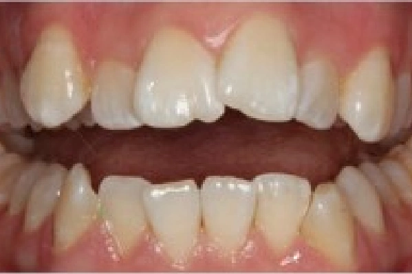 Before Invisalign - Crowded Teeth - View 3