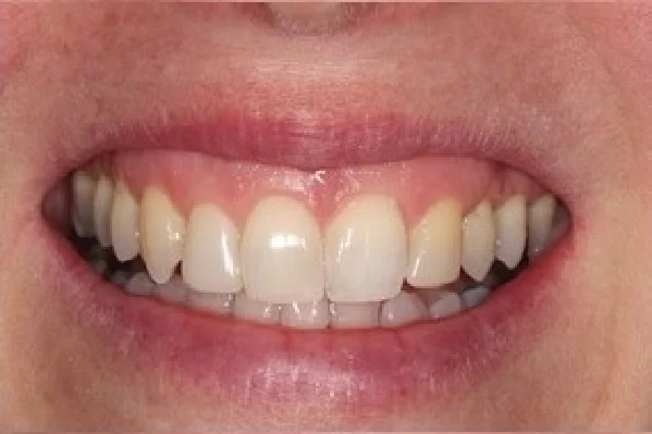 After Invisalign - Spaced Teeth