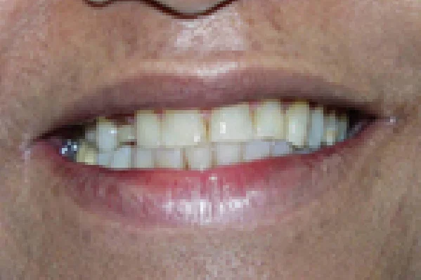 Before All Ceramic Crowns