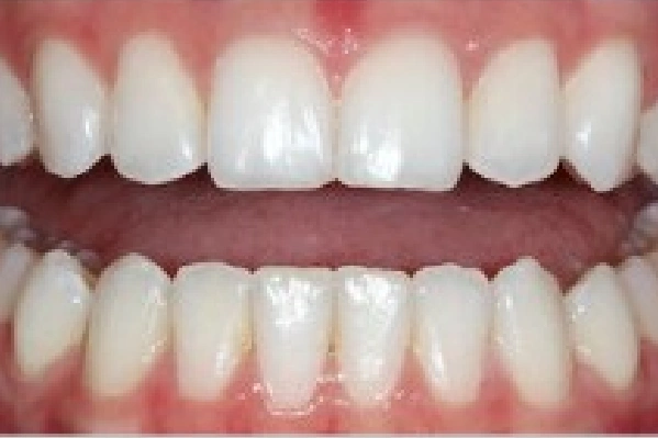 After  Invisalign - Uneven Smile