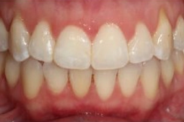 After Invisalign - Open Bite