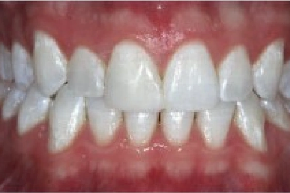 After Invisalign - Cross Bite