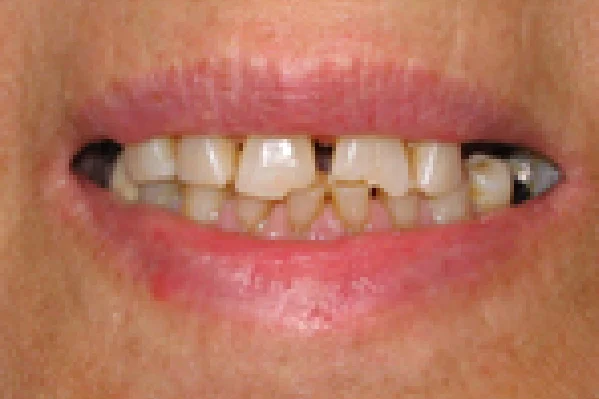 Before Full Mouth Rehabilitation