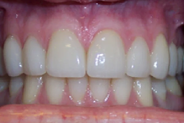 After Porcelain Veneers