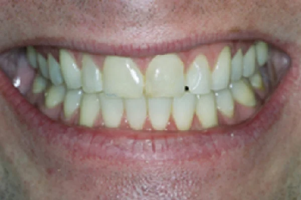 Before Porcelain Veneers