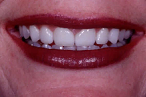 After Porcelain Veneers - View 2