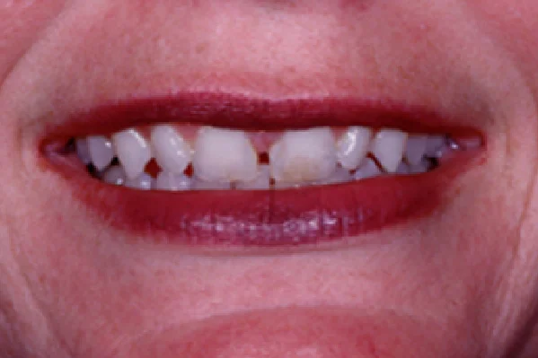 Before Porcelain Veneers - View 2