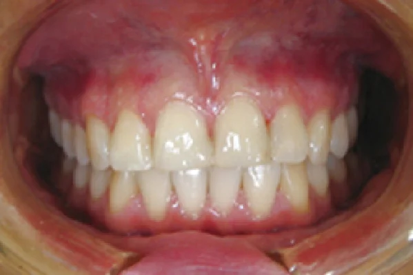 After Composite Veneers