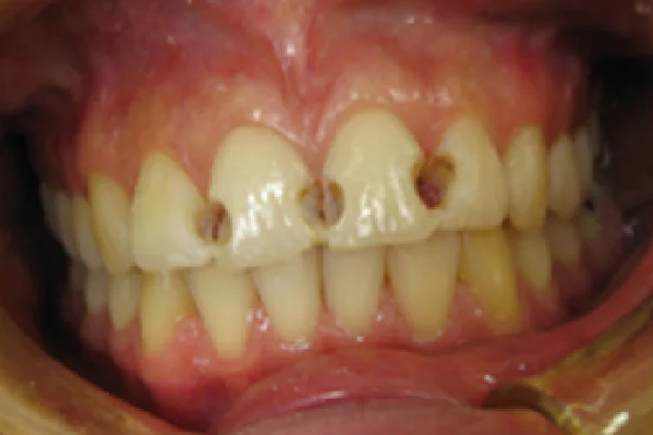 Before Composite Veneers